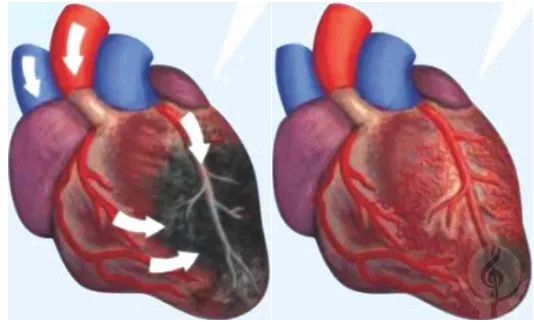 Шунтирование – без шунтирования